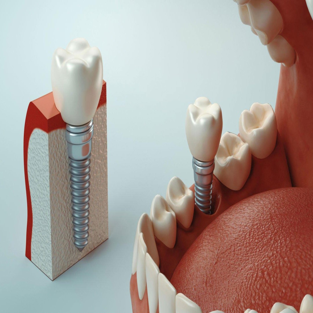 İmplant Destekli Protezler ve Manyetikli Protezler: Kaybedilen Dişlerin Tedavisi | 